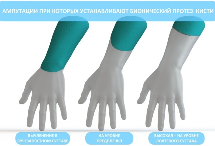 Prothèse bionique de la main. Prix, comment ça marche, où acheter, fabricant, photo