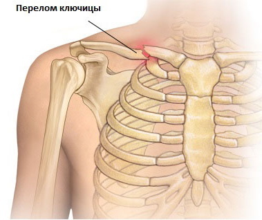 Smerter i kragebenet til venstre, høyre. Årsaker hos kvinner, menn