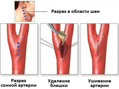 Neck vascular stenosis. Symptoms and treatment, surgery