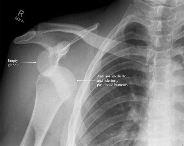 Dislocation of the shoulder joint