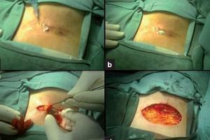Surgery to remove the coccygeal cyst