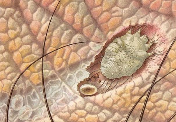 How does scabies manifest?