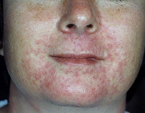 Forma oral de dermatite