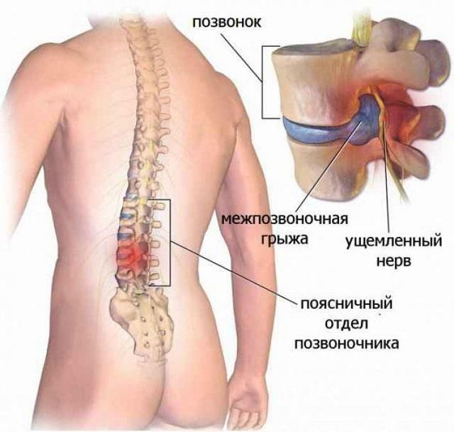 Reprezentarea schematică a coloanei vertebrale lombare herniene
