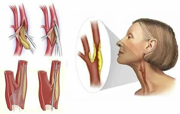 Ateroscleroza vaselor gâtului, capului. Simptome și tratament