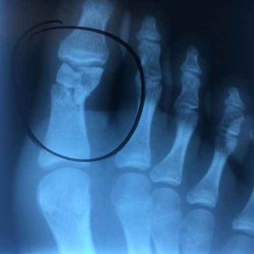 Fractura del dedo gordo del pie. Síntomas, cuánto sana, cómo curar, si es necesario un yeso, rehabilitación.