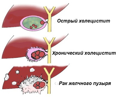 Doenças do fígado e da vesícula biliar. Sintomas, tratamento