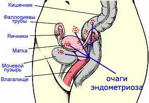 Endometriozė