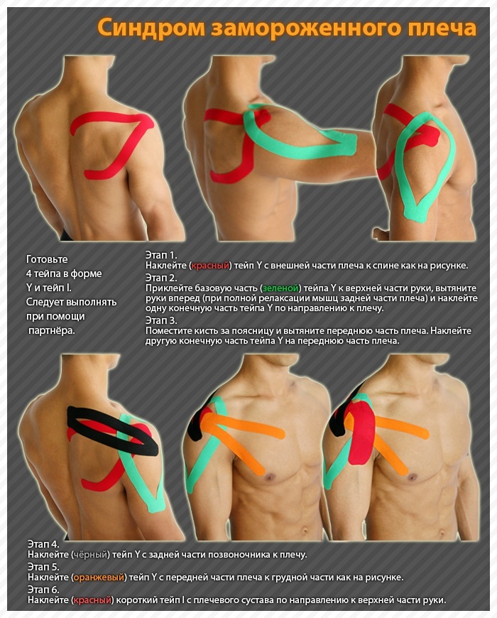 Мышцу зафиксировать. Тейпирование плечевого сустава кинезио тейп. Схема фиксации плечевого сустава тейпом. Тейпирование ушиб плечевого сустава. Тейпирование плечевого сустава при болях.
