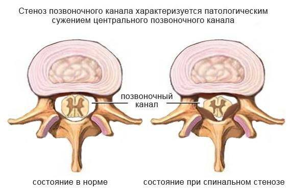 Zwężenie kanału kręgowego
