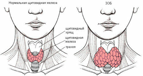 Hipertiroidismul și hipotiroidismul