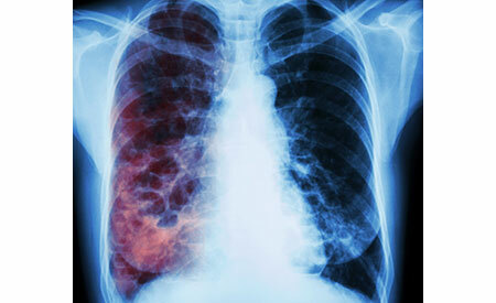 X-ray in tuberculosis, methods of diagnosis
