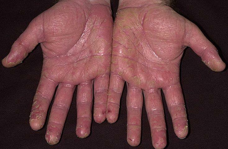 Dry eczema on the hands: what to treat
