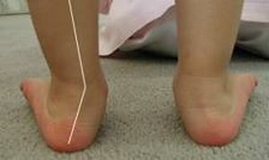 curvature of feet