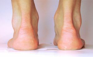 pronation of foot