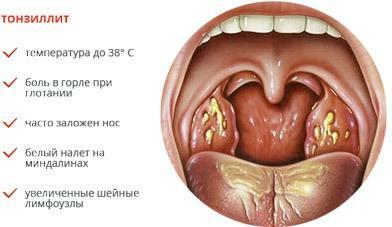 Amigdalita ca cauză de durere în gât
