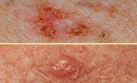 Foto di sintomi del cancro della pelle