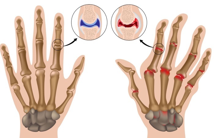 Rheumatoid arthritis. Diagnosis of blood, etiology, pathogenesis, causes, symptoms and treatment