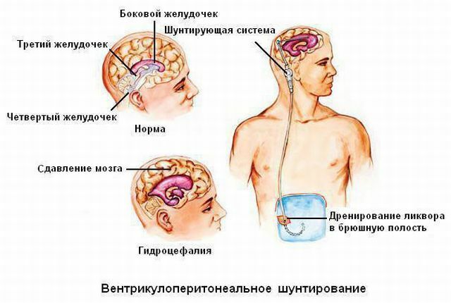 Normotenzivni hidrocefalus: simptomi, dijagnoza i liječenje
