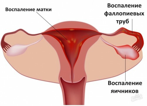 Ovarian Inflammation