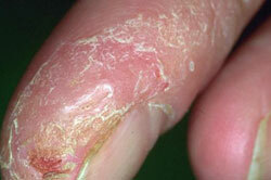 dry eczema, photo