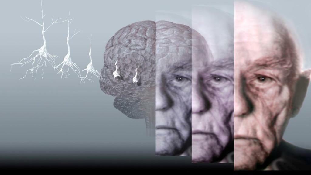 De ziekte van Alzheimer