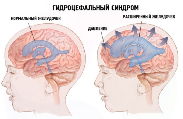 Wat is hydrocephalisch syndroom