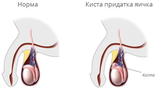 Testis sakit di sebelah kanan, di sebelah kiri pada pria, menarik perut bagian bawah. Penyebab, pengobatan