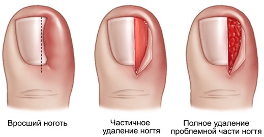 The big toe hurts. Causes, joints, nails, bone, pads when walking