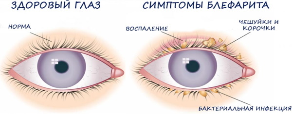 Swollen eyes in the morning. Causes of the upper, lower eyelid, how to remove, get rid of edema