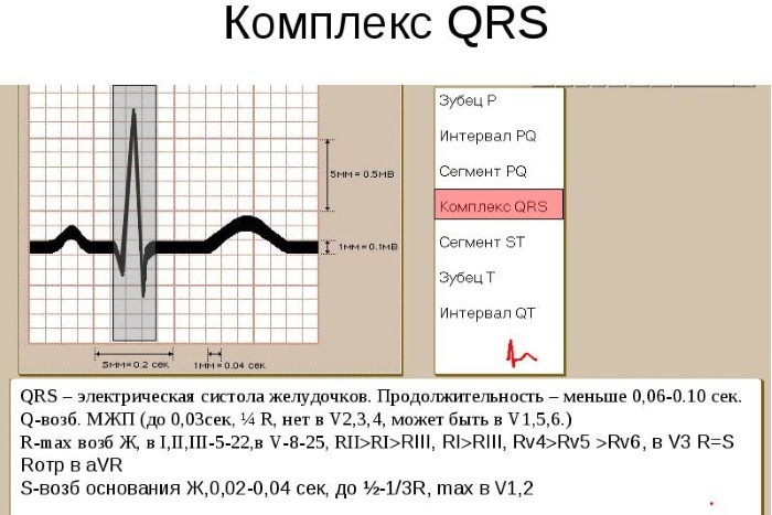 Idioventricular rhythm on the ECG. What does it mean, description, treatment, reasons. Photo