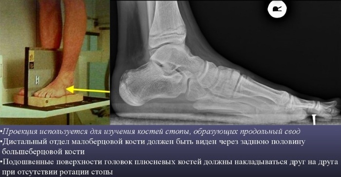 Ankle (ankle). Where is the person on the leg, photo, structure, thin, thick, what to do if it is swollen, hurts, dislocation, fracture, edema, bruise, arthrosis. Symptoms and Treatment