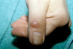 Swelling of the finger