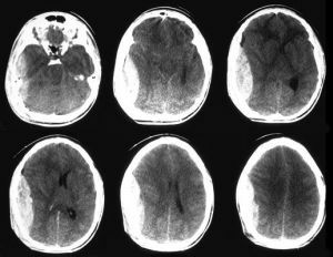 Hematoma dengan MRI