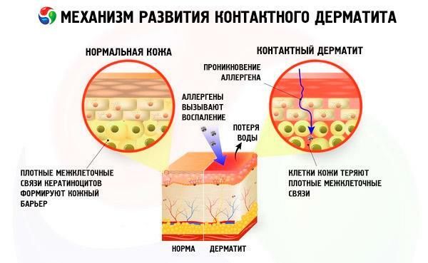 Mekanismen för kontaktdermatit