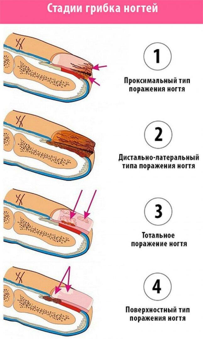 Stages of fungus nails