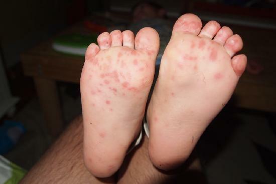 Fungus of the foot - photo