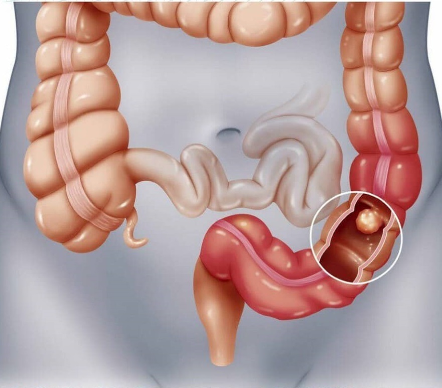 Úlceras intestinales