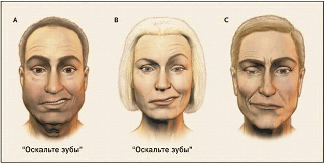 Co může způsobit parézu nervového obličeje - příčiny, symptomy a léčbu patologie