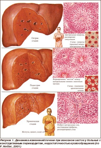 Hepatomegalia moderada do fígado. O que há com um adulto, uma criança
