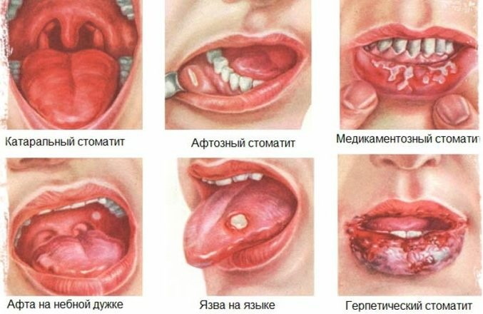 Stomatitis na dlesni. Mazila, zdravljenje za otroke, odrasle