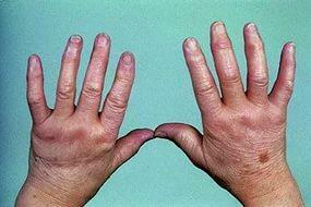 Artrite infecciosa