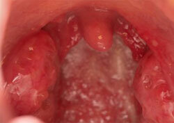Purulent coating, photo of throat