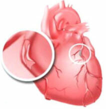 Les symptômes et les signes de la cardiopathie ischémique - CHD