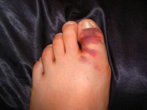 a fracture of the toe