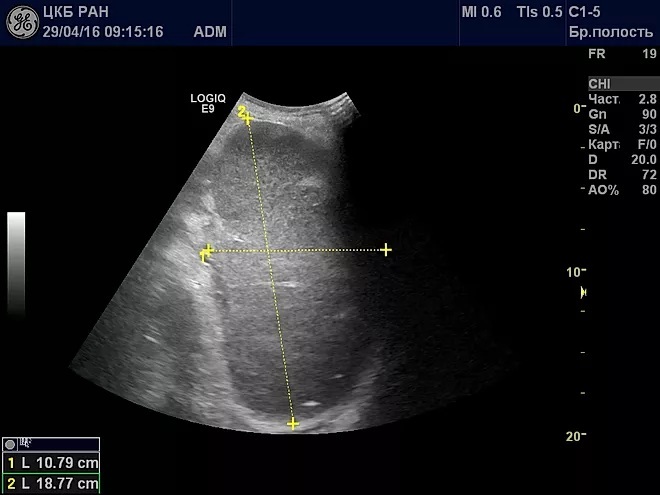 Splenomegaly. What is it, how to treat, causes of moderate, minor, portal, severe, analyzes