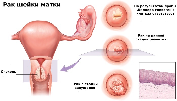 GGE in gynecology. What is it, symptoms, treatment with hormones, folk remedies, causes, consequences