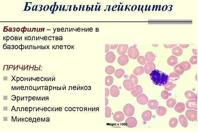 Blood leukocytosis. What is it in adults, children, pregnant women, causes, treatment, consequences