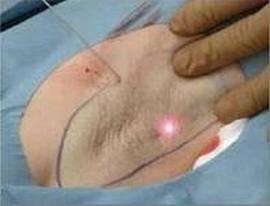Treatment of hyperhidrosis with laser: price, testimonials, photos