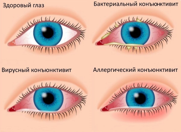 Drops for eyes from inflammation and redness, improve vision. List of cheap, prices, reviews